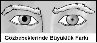 Koma, bayılma ve baş yaralanmaları - açıklayıcı şekil 1