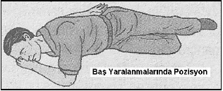 Koma, bayılma ve baş yaralanmaları - açıklayıcı şekil 1