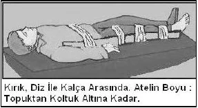 Kırıklar, çıkıklar ve burkulmalar - açıklayıcı şekil 2